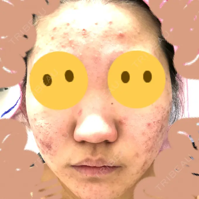 ピーリング（ニキビ・毛穴） / イオン導入 / エレクトロポレーション 湘南美容クリニック 宇都宮院 DAY 13 メイン用