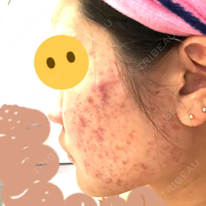 ピーリング（ニキビ・毛穴） / イオン導入 / エレクトロポレーション 湘南美容クリニック 宇都宮院 DAY 13 メイン用