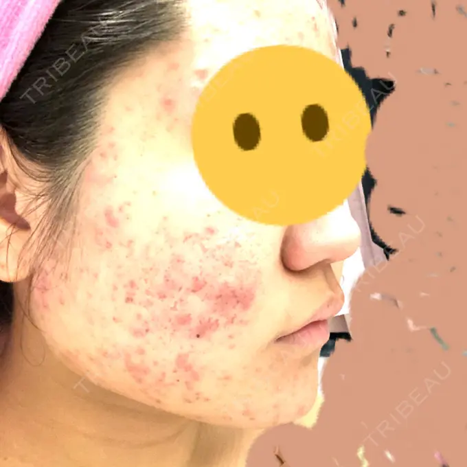 ピーリング（ニキビ・毛穴） / イオン導入 / エレクトロポレーション 湘南美容クリニック 宇都宮院 DAY 13 メイン用