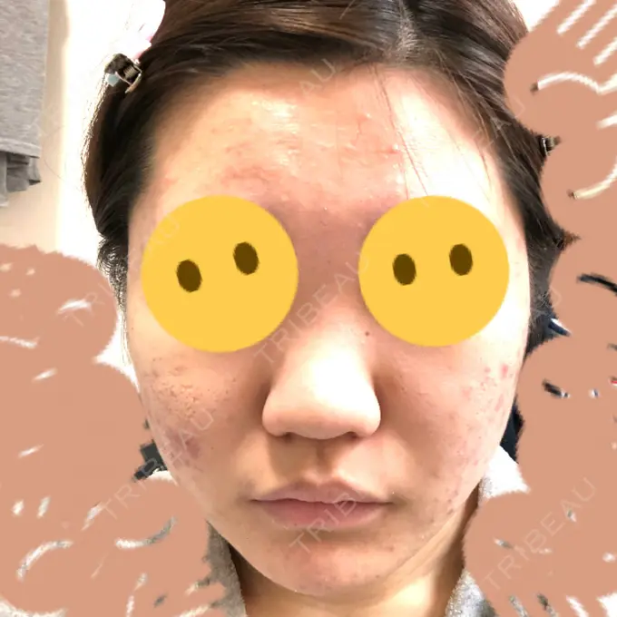 ピーリング（ニキビ・毛穴） / イオン導入 / エレクトロポレーション 湘南美容クリニック 宇都宮院 AFTER メイン用