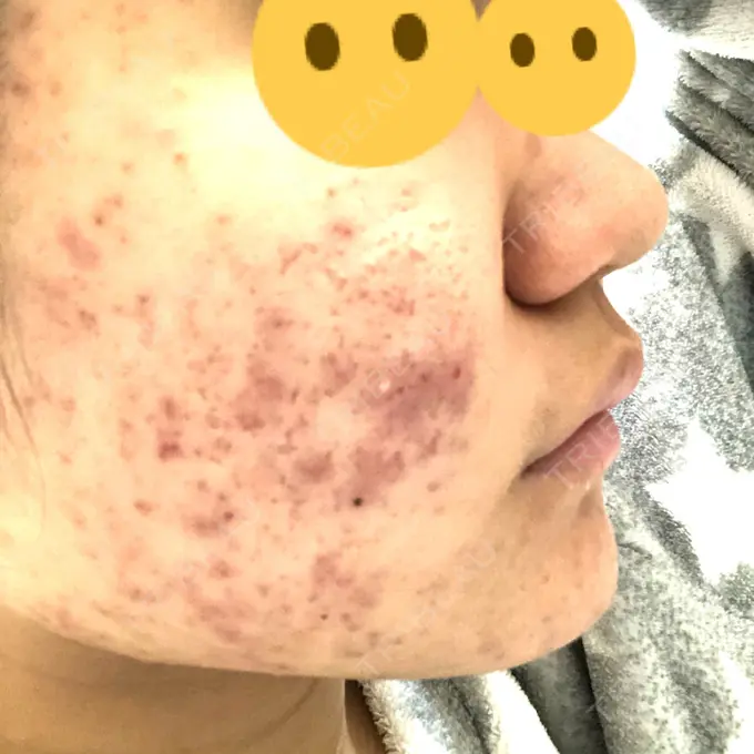 ピーリング（ニキビ・毛穴） / イオン導入 / エレクトロポレーション 湘南美容クリニック 宇都宮院 DAY 17 メイン用