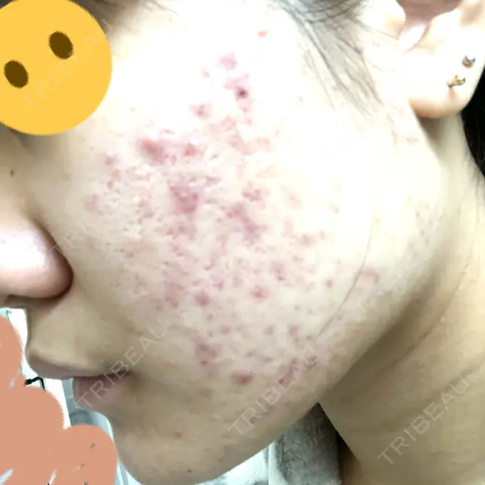 ピーリング（ニキビ・毛穴） / イオン導入 / エレクトロポレーション 湘南美容クリニック 宇都宮院 DAY 17 メイン用