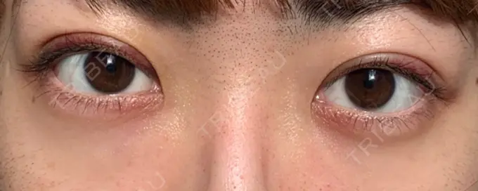 二重埋没 東京イセアクリニック DAY 8 メイン用