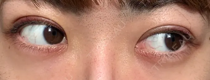 二重埋没 東京イセアクリニック DAY 8 メイン用