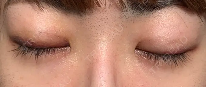 二重埋没 東京イセアクリニック DAY 8 メイン用