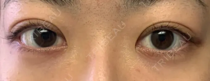 二重埋没 東京イセアクリニック AFTER メイン用