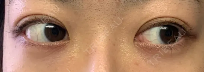 二重埋没 東京イセアクリニック DAY 50 メイン用