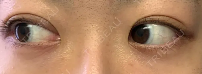 二重埋没 東京イセアクリニック DAY 50 メイン用