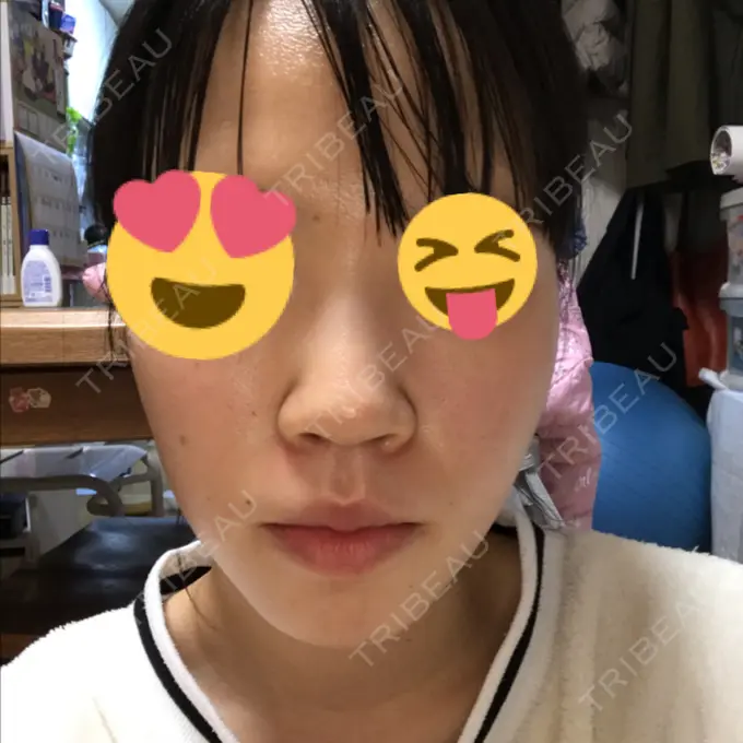 毛穴洗浄（ハイドラフェイシャルなど） 神成（こうせい）美容外科 DAY 8 メイン用