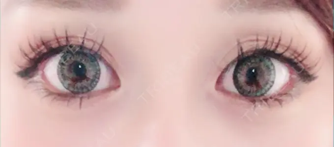 タレ目形成・グラマラスライン（切開） / その他（目元） グローバルビューティークリニック 大阪院 DAY 21 メイン用