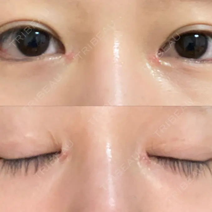 蒙古ひだ形成 / 目元修正 銀座高須クリニック DAY 23 メイン用