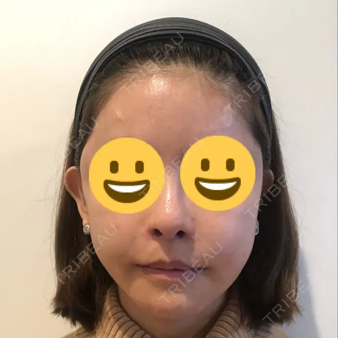 あごプロテーゼ / 前額リフト / 切開リフト THE PLAN（ザ・プラン）美容整形外科・皮膚科 AFTER メイン用