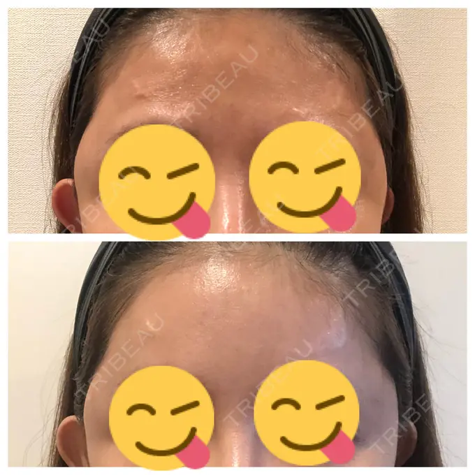 あごプロテーゼ / 前額リフト / 切開リフト THE PLAN（ザ・プラン）美容整形外科・皮膚科 DAY 30 メイン用