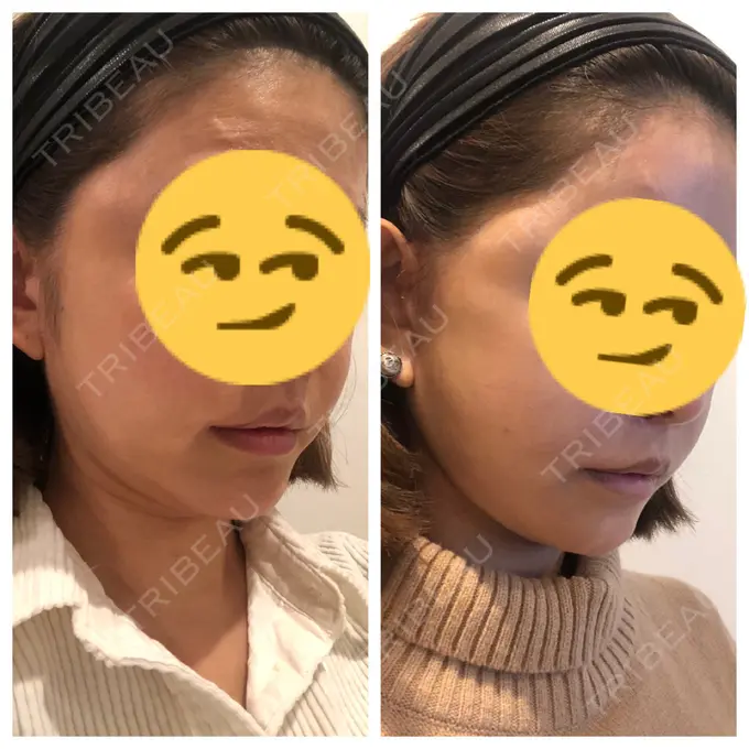 あごプロテーゼ / 前額リフト / 切開リフト THE PLAN（ザ・プラン）美容整形外科・皮膚科 DAY 30 メイン用