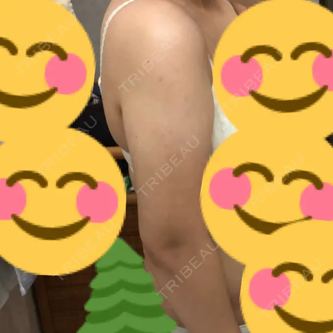 脂肪吸引（二の腕） 湘南美容クリニック 岡山院 DAY 92 メイン用