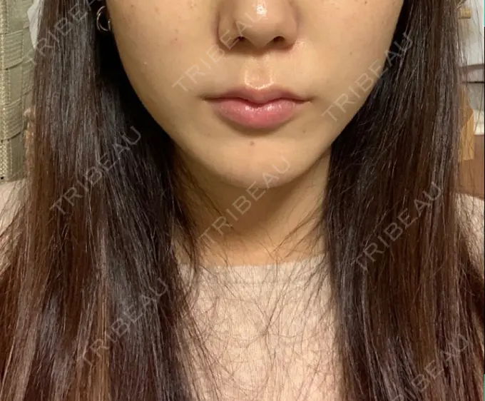 脂肪溶解注射（顔） 赤坂プレミアクリニック AFTER メイン用