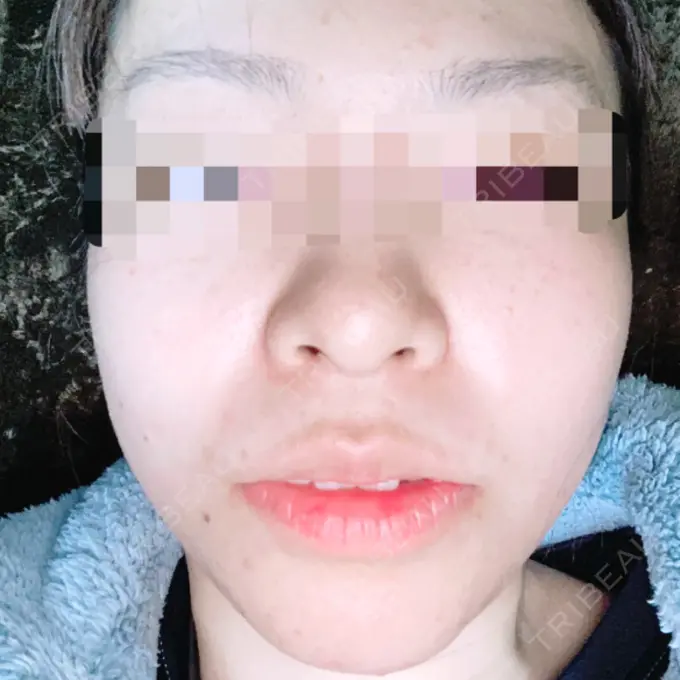 その他（目元） 青山セレスクリニック 青山院 DAY 69 メイン用