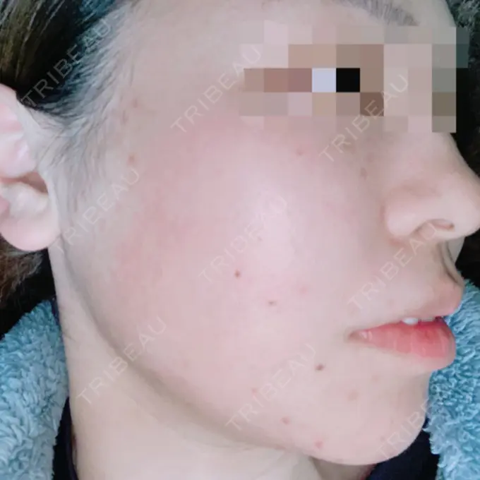 その他（目元） 青山セレスクリニック 青山院 DAY 69 メイン用