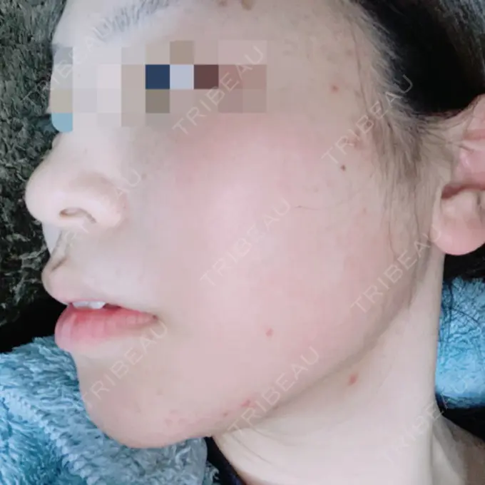 その他（目元） 青山セレスクリニック 青山院 DAY 69 メイン用