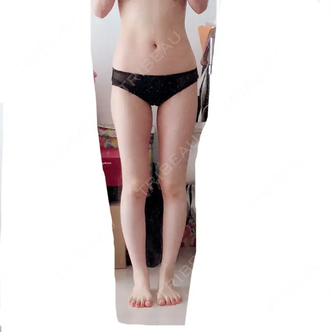 脂肪吸引（脚） / 豊胸（脂肪注入） 神戸中央クリニック美容外科 DAY 55 メイン用