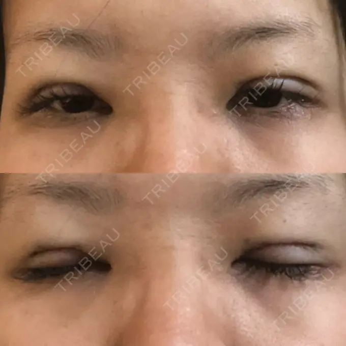 二重切開 / 目元修正 きくな湯田眼科 DAY 0 メイン用