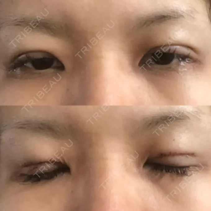 二重切開 / 目元修正 きくな湯田眼科 DAY 1 メイン用