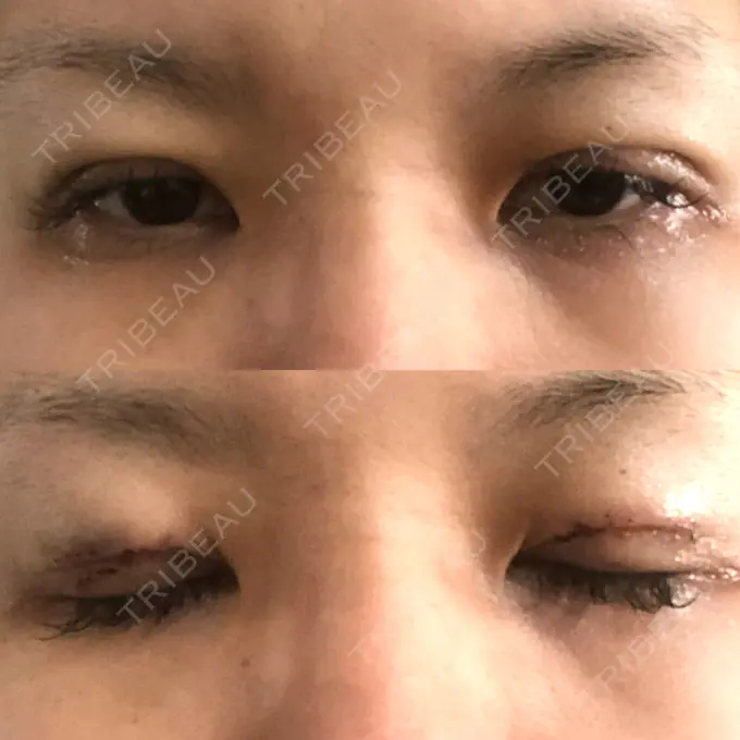 二重切開 / 目元修正 きくな湯田眼科 DAY 2 メイン用