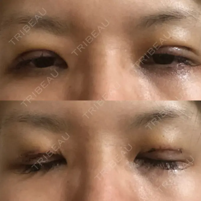 二重切開 / 目元修正 きくな湯田眼科 DAY 3 メイン用