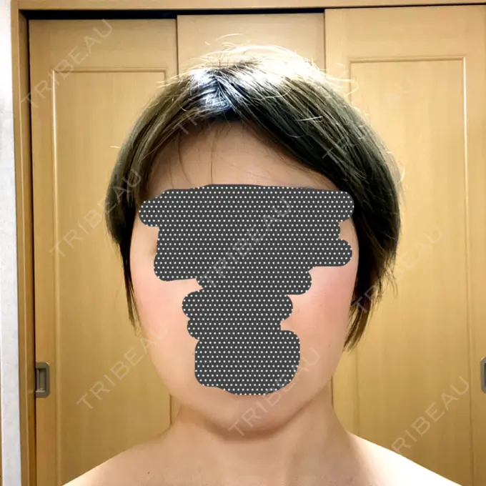 ボトックス（エラ・小顔） / 脂肪溶解注射（顔） チョンダムジュエンクリニック DAY 29 メイン用