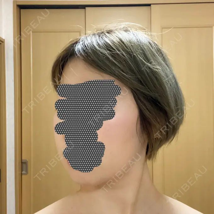 ボトックス（エラ・小顔） / 脂肪溶解注射（顔） チョンダムジュエンクリニック DAY 29 メイン用