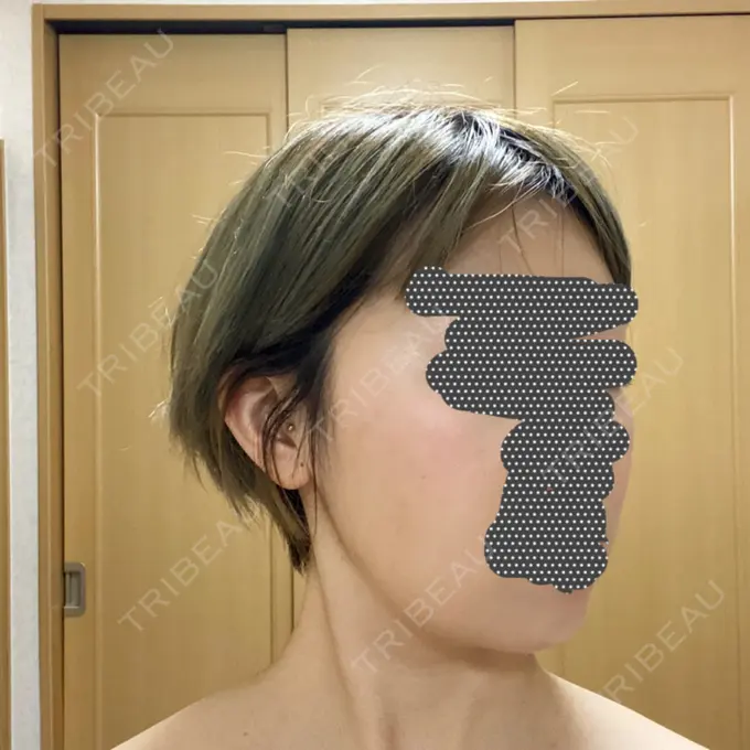 ボトックス（エラ・小顔） / 脂肪溶解注射（顔） チョンダムジュエンクリニック DAY 29 メイン用