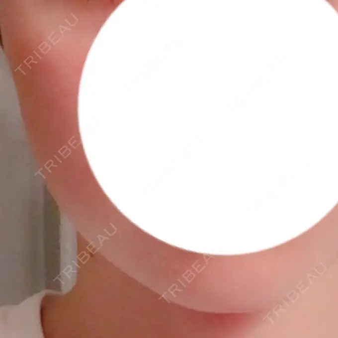 ボトックス（エラ・小顔） 湘南美容クリニック 仙台院 DAY 8 メイン用