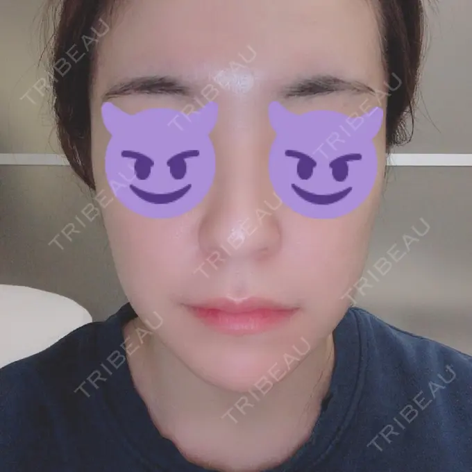 骨切り（あご） / 骨削り（エラ） / 輪郭修正 / その他（輪郭） RG整形外科（旧リオン整形外科） DAY 91 メイン用