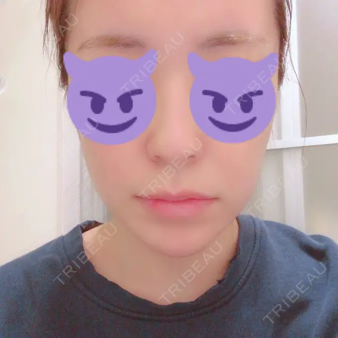 骨切り（あご） / 骨削り（エラ） / 輪郭修正 / その他（輪郭） RG整形外科（旧リオン整形外科） DAY 130 メイン用