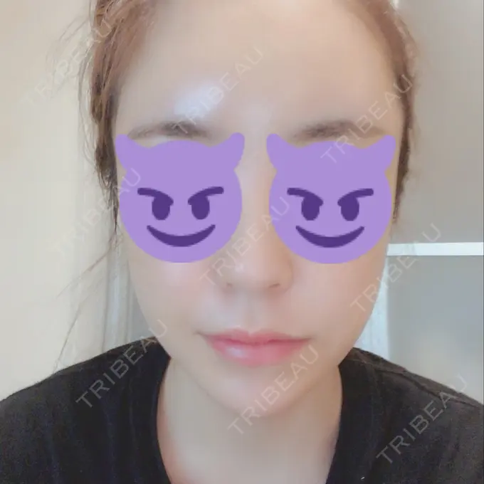 骨切り（あご） / 骨削り（エラ） / 輪郭修正 / その他（輪郭） RG整形外科（旧リオン整形外科） DAY 175 メイン用