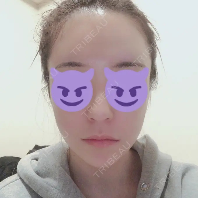 骨切り（あご） / 骨削り（エラ） / 輪郭修正 / その他（輪郭） RG整形外科（旧リオン整形外科） AFTER メイン用