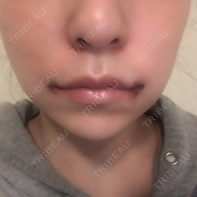 口角挙上 現代美学整形外科 DAY 1 メイン用