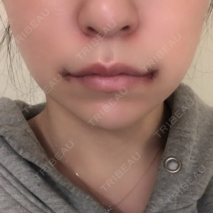 口角挙上 現代美学整形外科 DAY 2 メイン用