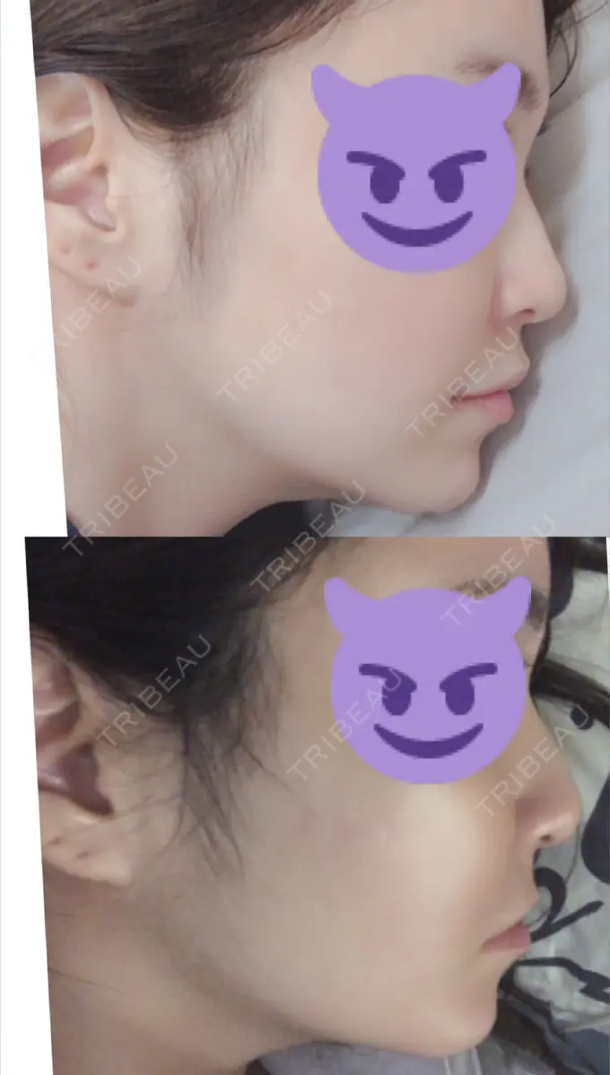 口角挙上 現代美学整形外科 DAY 3 メイン用