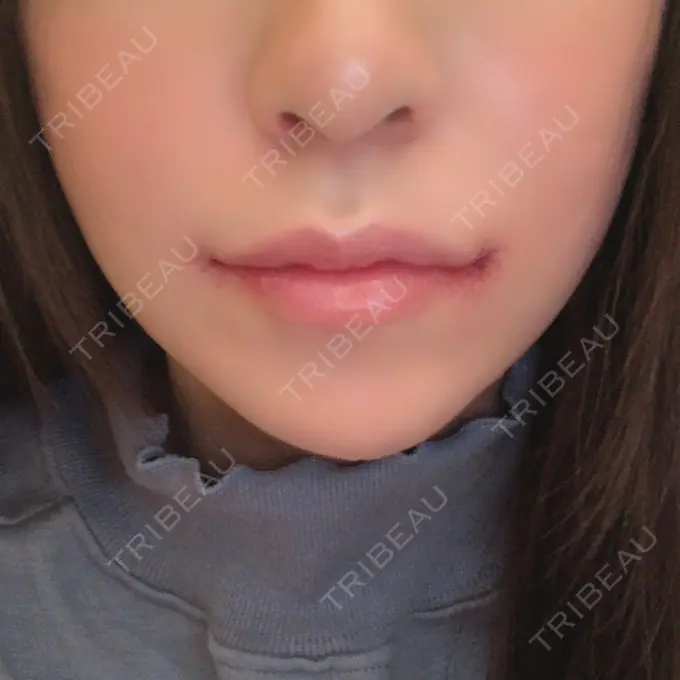 口角挙上 現代美学整形外科 DAY 6 メイン用