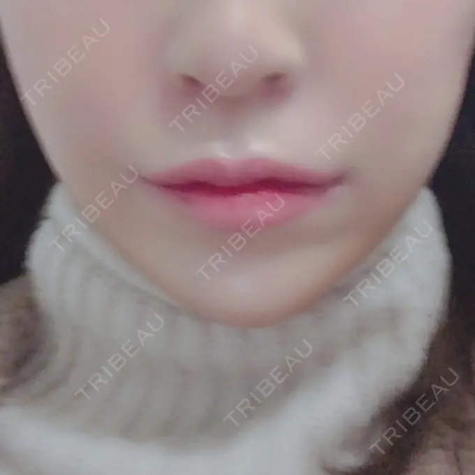 口角挙上 現代美学整形外科 DAY 6 メイン用