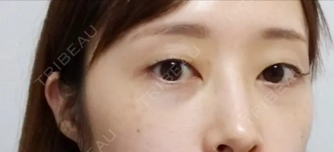 クマ治療 プラストクリニック DAY 0 メイン用