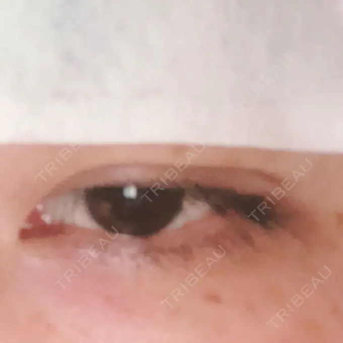 二重埋没 湘南美容クリニック 京都院 DAY 1 メイン用