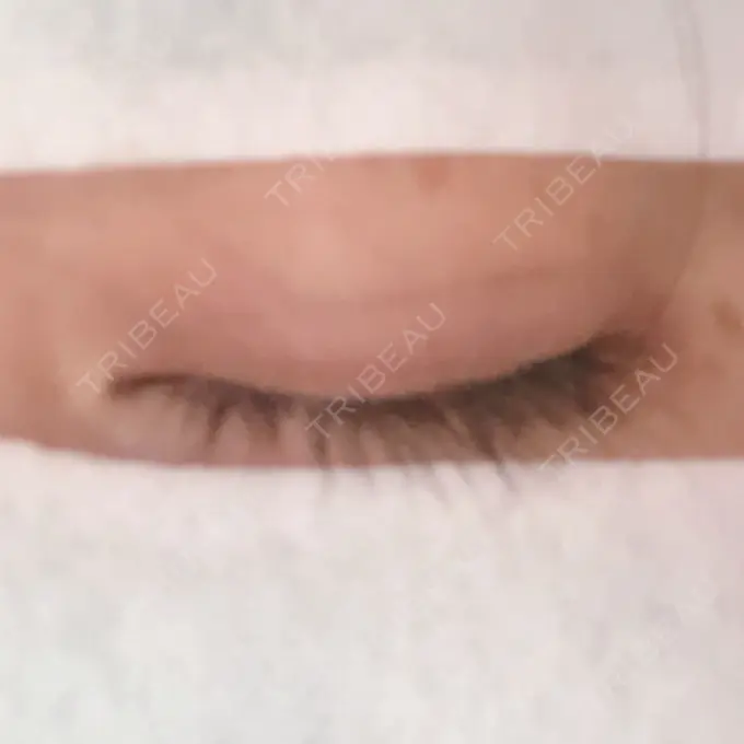 二重埋没 湘南美容クリニック 京都院 DAY 1 メイン用