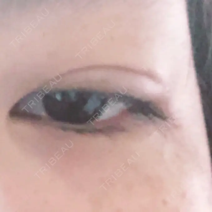 二重埋没 湘南美容クリニック 京都院 DAY 1 メイン用