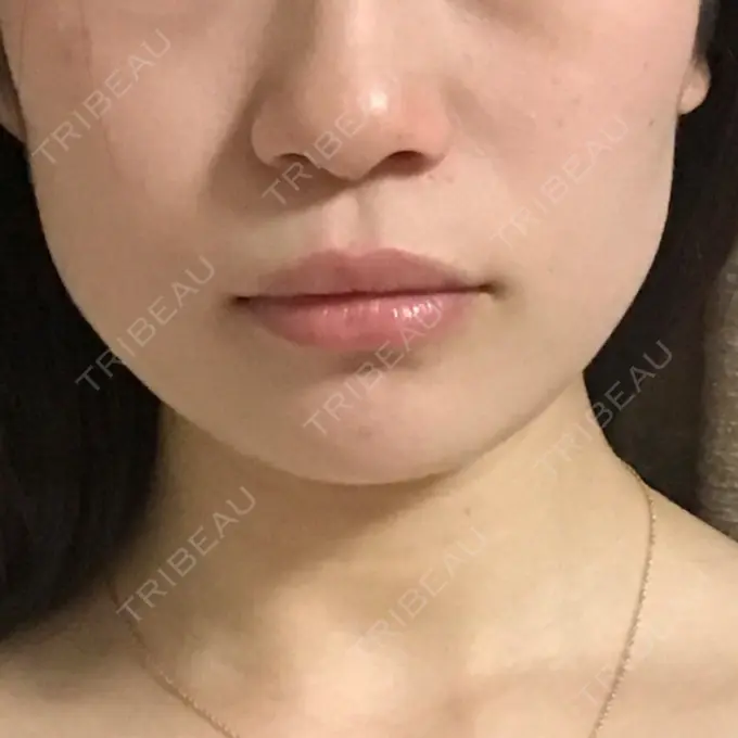 ボトックス（エラ・小顔） / 脂肪溶解注射（顔） 湘南美容クリニック 仙台院 DAY 3 メイン用