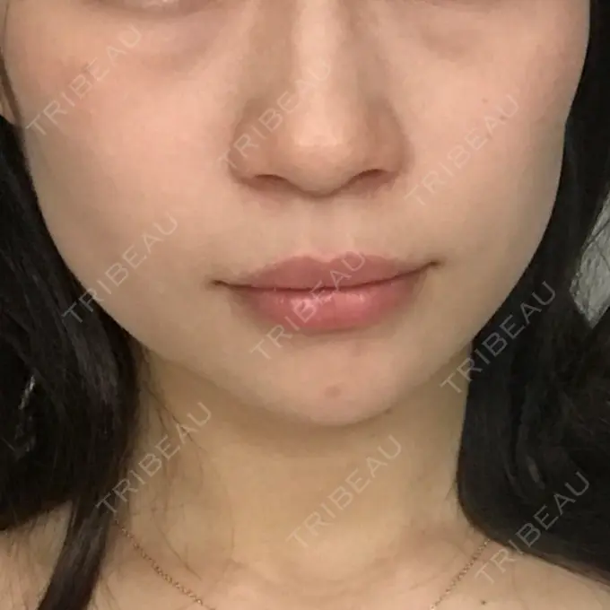 ボトックス（エラ・小顔） / 脂肪溶解注射（顔） 湘南美容クリニック 仙台院 DAY 4 メイン用