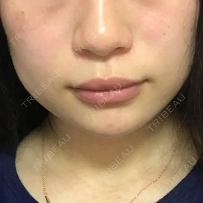 ボトックス（エラ・小顔） / 脂肪溶解注射（顔） 湘南美容クリニック 仙台院 DAY 6 メイン用