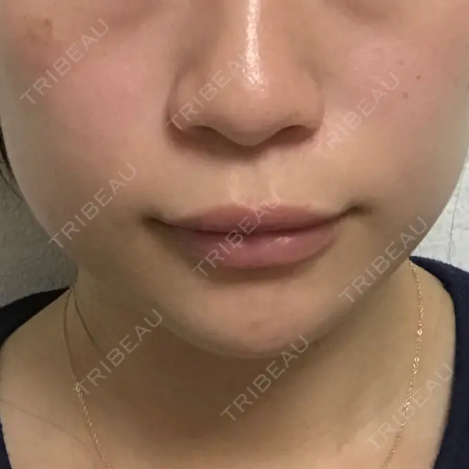 ボトックス（エラ・小顔） / 脂肪溶解注射（顔） 湘南美容クリニック 仙台院 DAY 7 メイン用