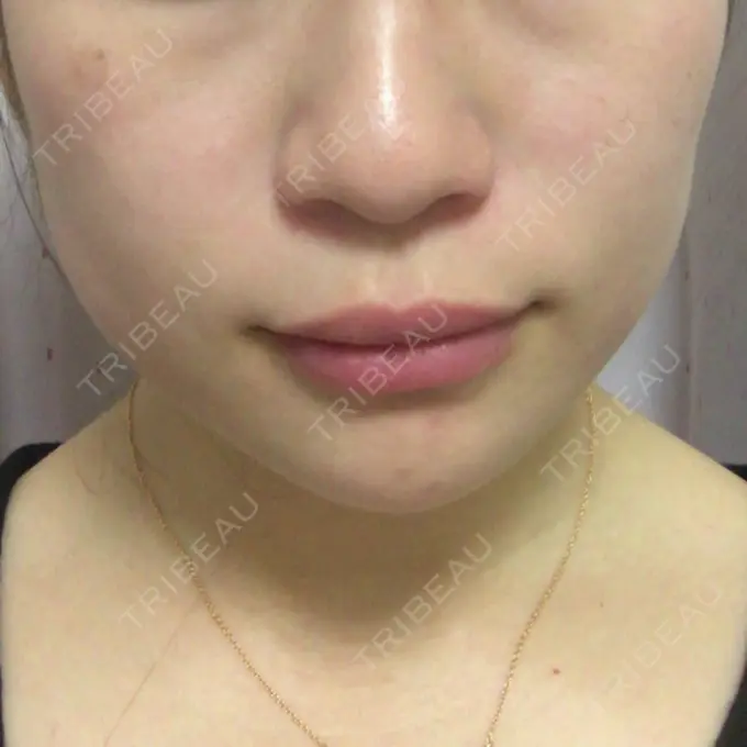 ボトックス（エラ・小顔） / 脂肪溶解注射（顔） 湘南美容クリニック 仙台院 DAY 8 メイン用